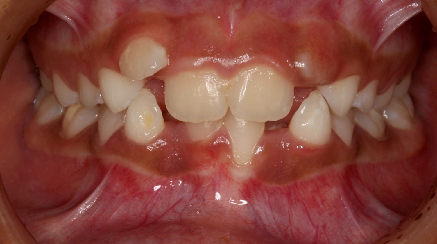 Before Image: 2-Phase Treatment - front